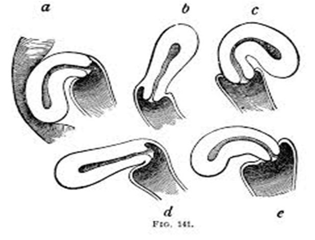 Displacement of the uterus and what is the retroversion and retroflexion?